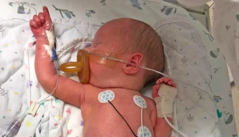 Newborn with a congenital abdominal wall defect (gastroschisis) showing intestines protected with a sterile wrap in a neonatal care setting