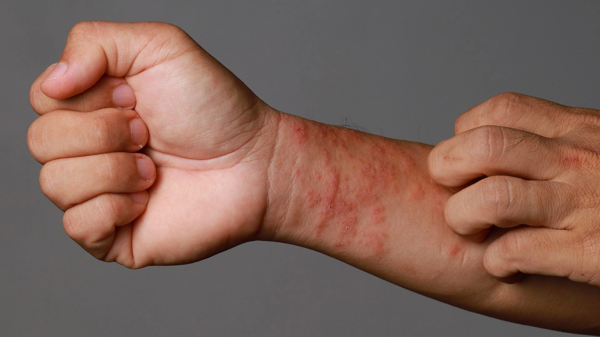 Eczedone natural eczema relief cream with aloe vera, coconut oil, and shea butter for soothing itchy and sensitive skin